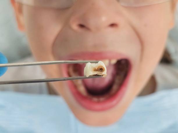 Best Root Canal Emergency Dentist  in Darrington, WA